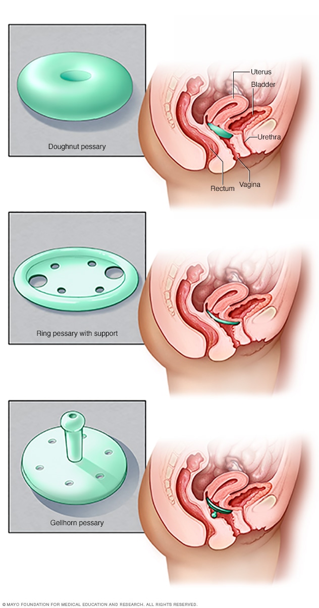 Anterior vaginal prolapse (cystocele) - Diagnosis and treatment - Mayo  Clinic