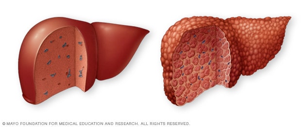 Normal liver and liver cirrhosis