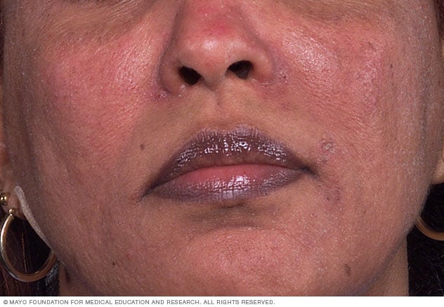 Rosacea on brown or Black skin can cause patches of brown discoloration.