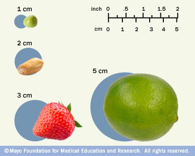 Tumor Size Chart Brain