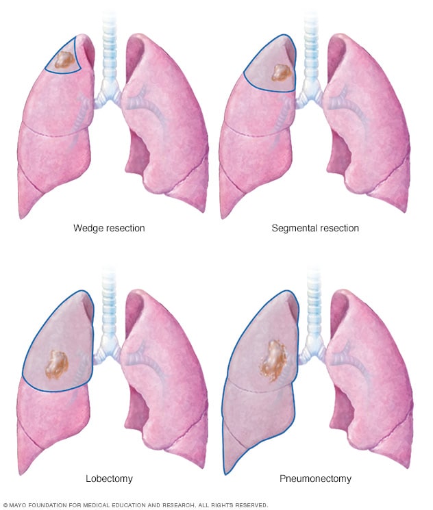 Cirugía de cáncer de pulmón