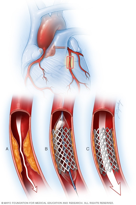 Balloon to widen a coronary artery