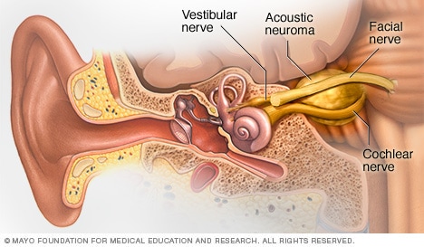 Illustration showing acoustic neuroma