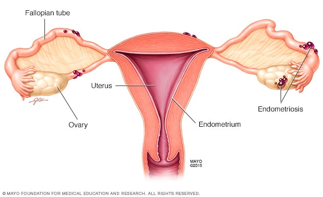 子宫和卵巢上的子宫内膜异位症沉积物