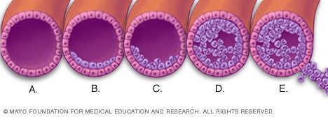 Illustration showing how breast cancer develops