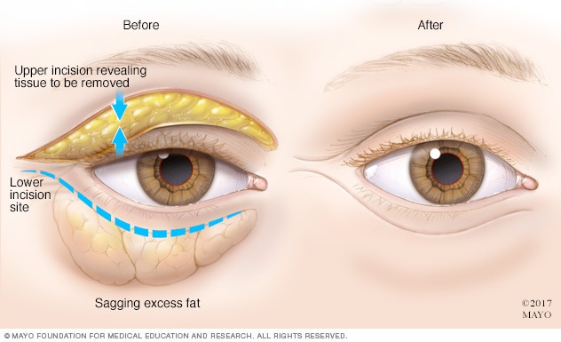 Cómo se realiza una blefaroplastia 