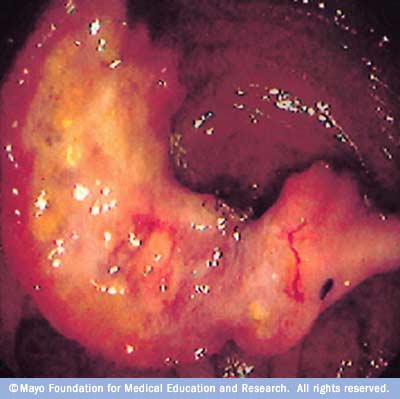 Image showing colon cancer