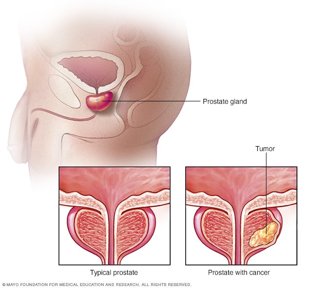 Comparación entre una próstata normal y una con tumor