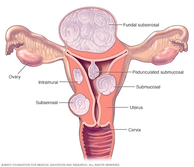 Uterine fibroids - Symptoms and causes - Mayo Clinic