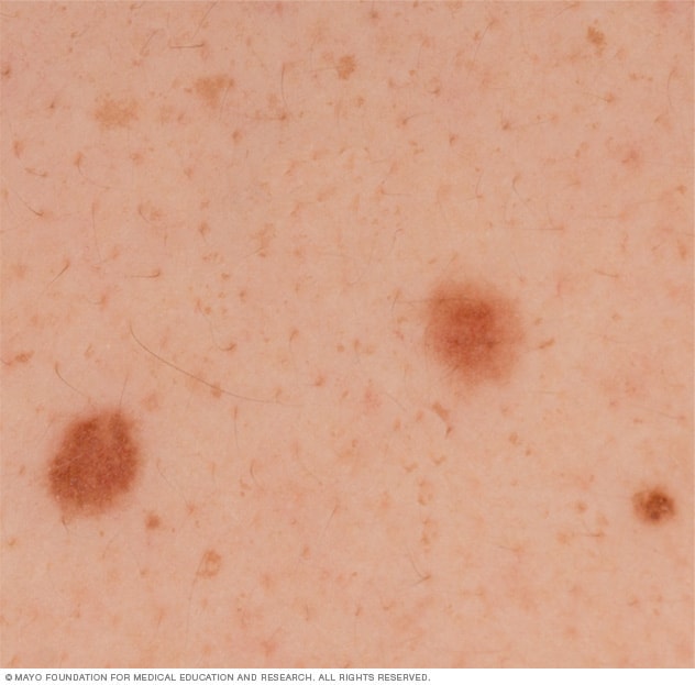 A melanoma look what like does Melanoma Warning