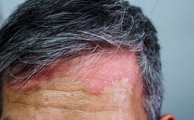 Psoriasis del cuero cabelludo 