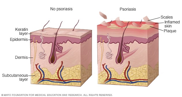 scalp psoriasis complications)