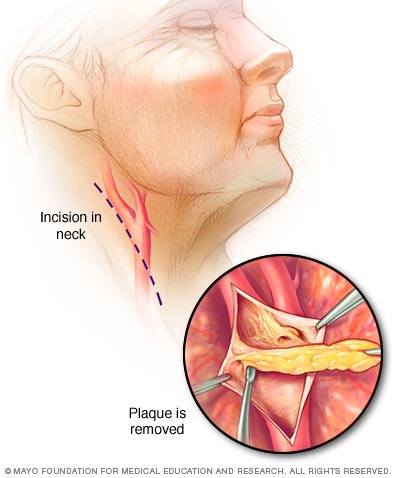 颈动脉内膜切除术的步骤