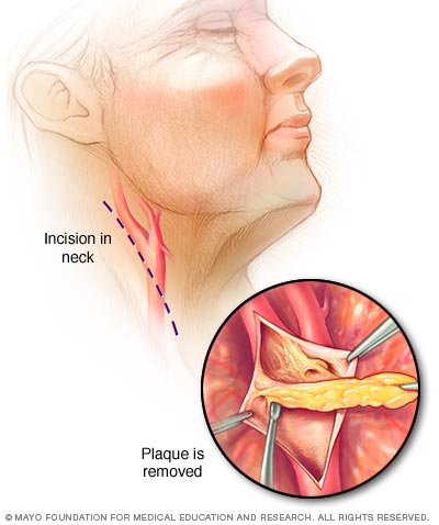 Carotid Artery Disease Diagnosis And Treatment Mayo Clinic