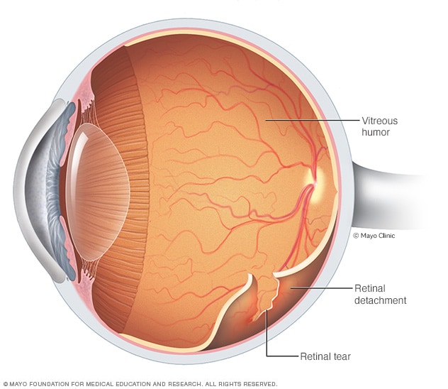 Retinal detachment - Symptoms and causes - Mayo Clinic