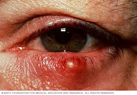 Stye sty Symptoms And Causes Mayo Clinic