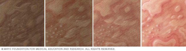 Hives on four different skin colors.