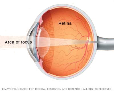 Farsightedness (hyperopia) 