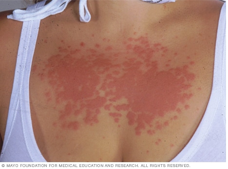 Marquee ris spisekammer Polymorphous light eruption - Symptoms and causes - Mayo Clinic