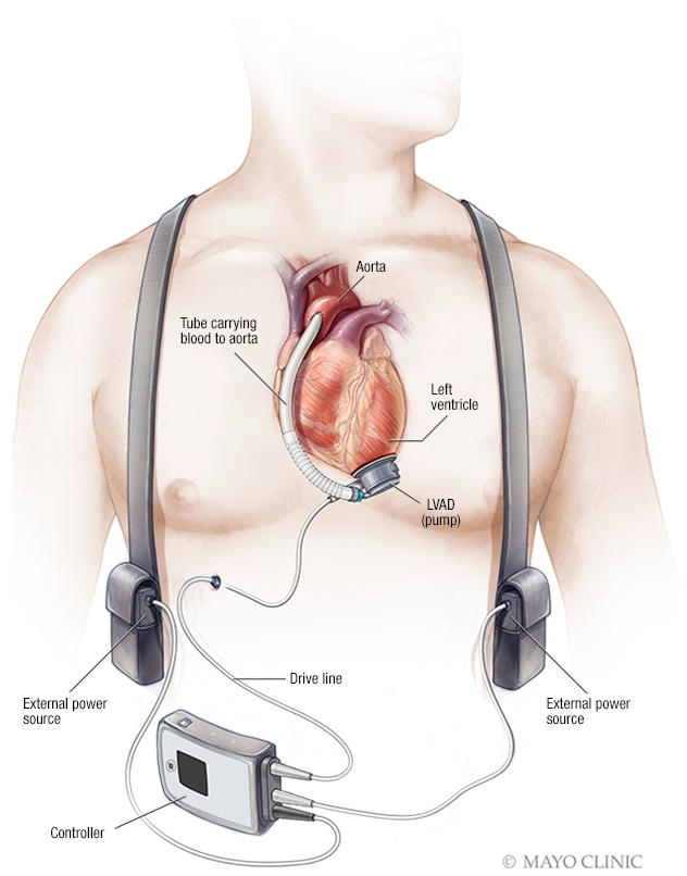 左心室辅助装置 (LVAD)