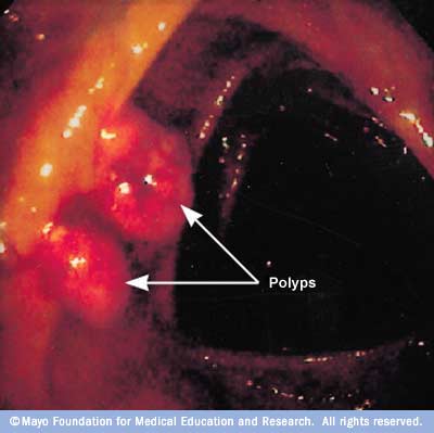 Image showing small polyps