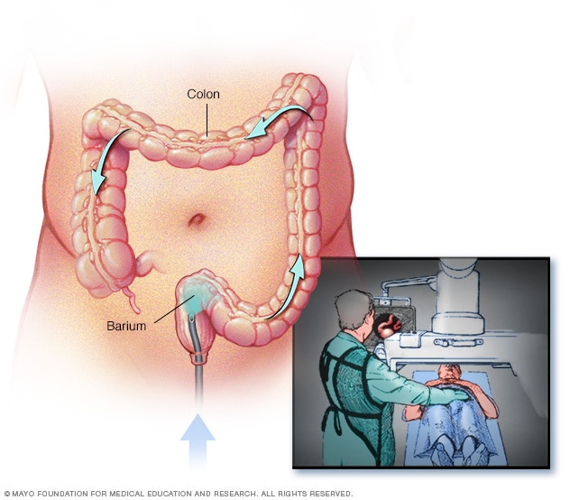 Illustration of barium enema