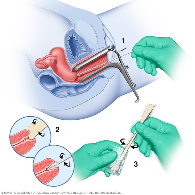 اختبار سرطان عنق الرحم (Pap)