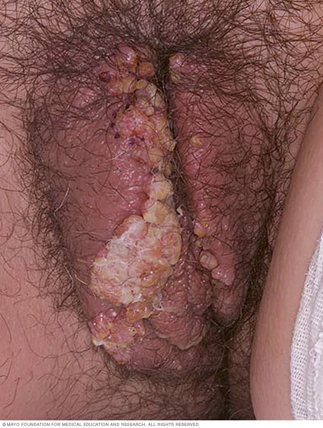 Female genital warts