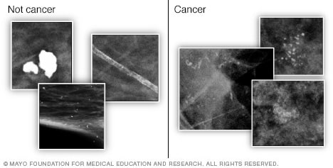 Imágenes de mamografía que muestran calcificaciones en las mamas