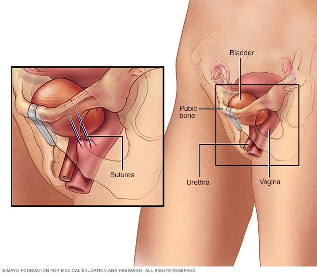 leiderschap Knikken eigendom Surgery for stress urinary incontinence in women - Mayo Clinic