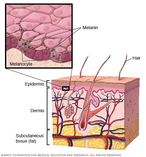 Sunburn Severity Chart