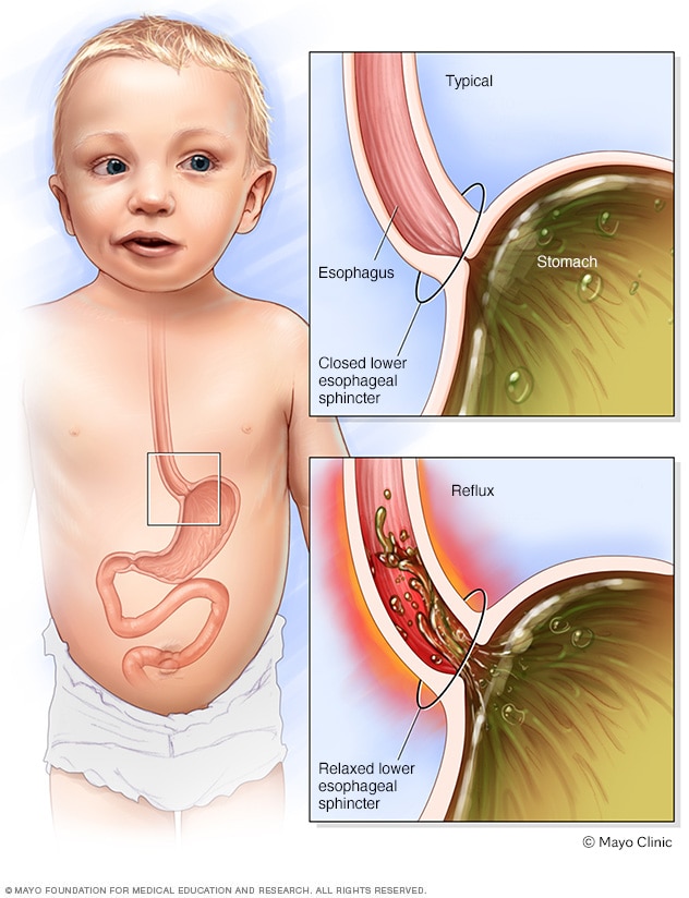 婴儿胃食管反流是怎么发生的