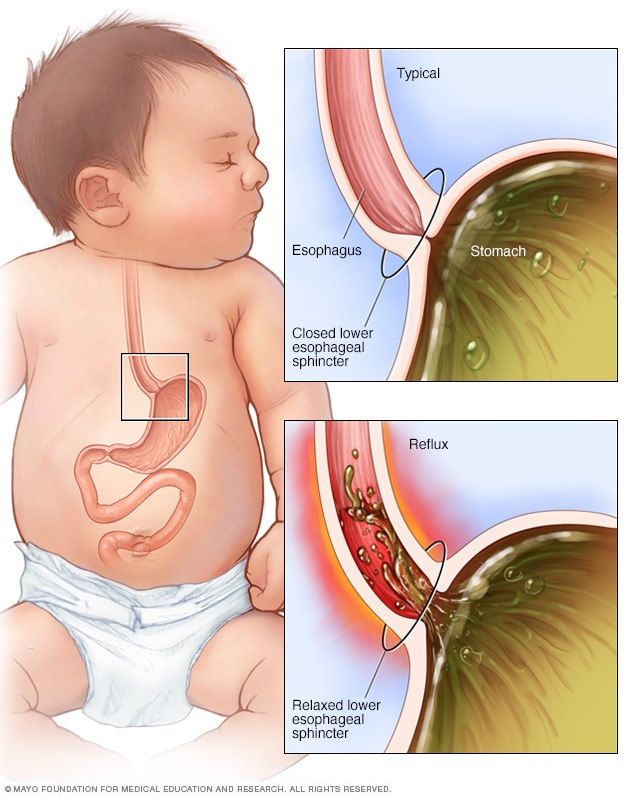 How infant reflux occurs