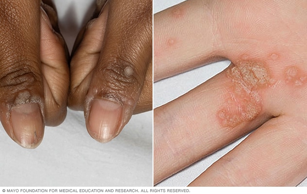 warts on hands are caused by