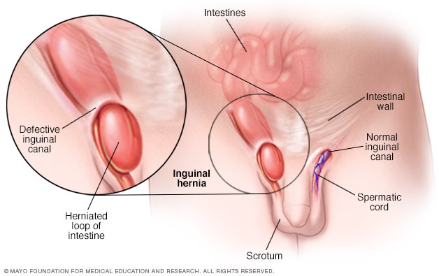 Illustration of an inguinal hernia on a male