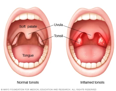 what causes tonsillitis)