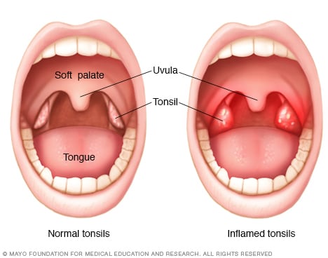 Tonsils