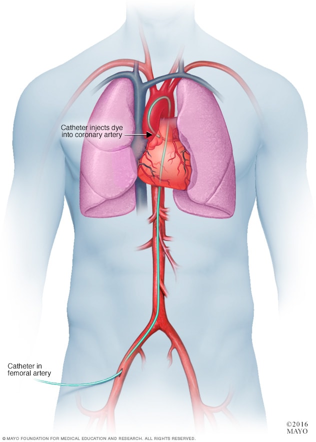 Coronary angiogram Mayo Clinic