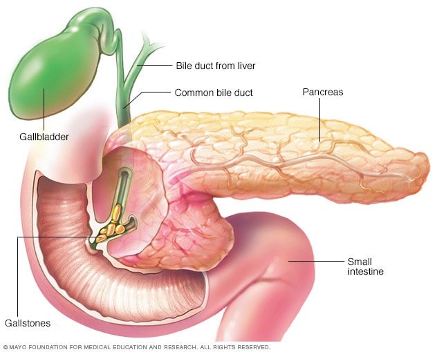 Pancreatitis causada por cálculos biliares 