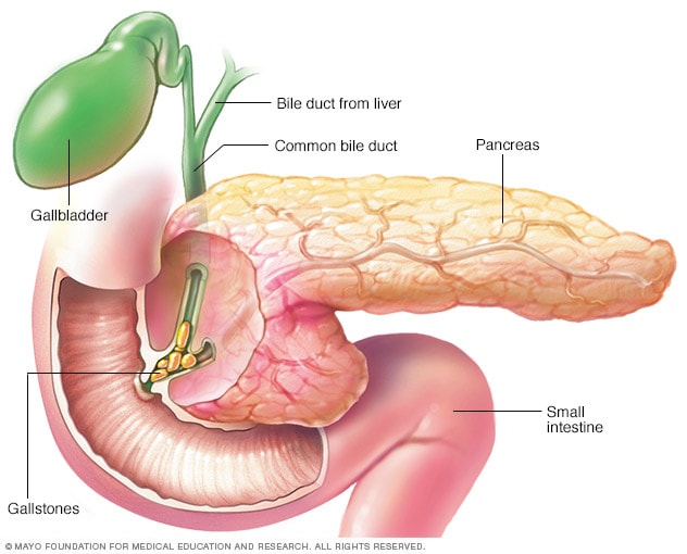 Pancreatitis causada por cálculos biliares 