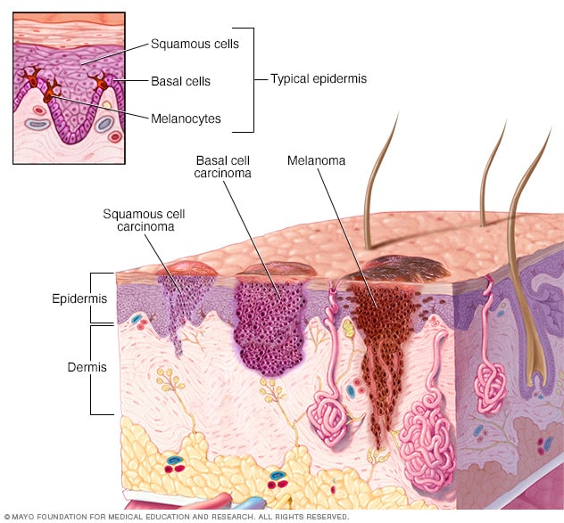 موقع تطور سرطان الجلد 