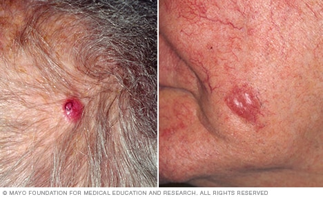 Photograph showing Merkel cell carcinoma 