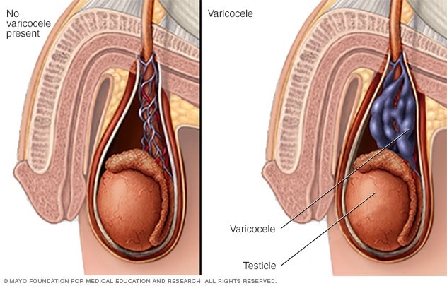 varicele varicoase prostata