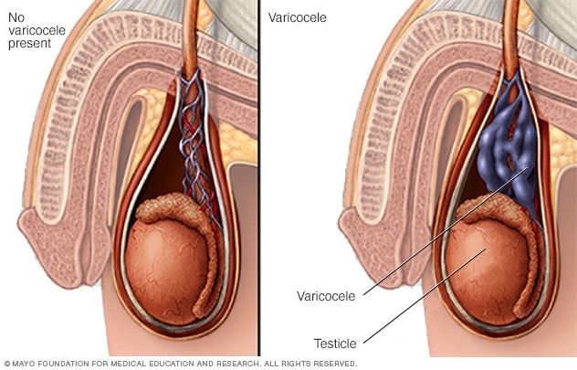 Varicocele
Es cuando se presenta una dilatación en las venas esta es similar o se puede comparar con una vena varicosa