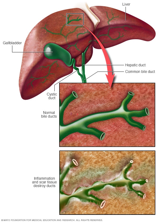 Bile duct damage