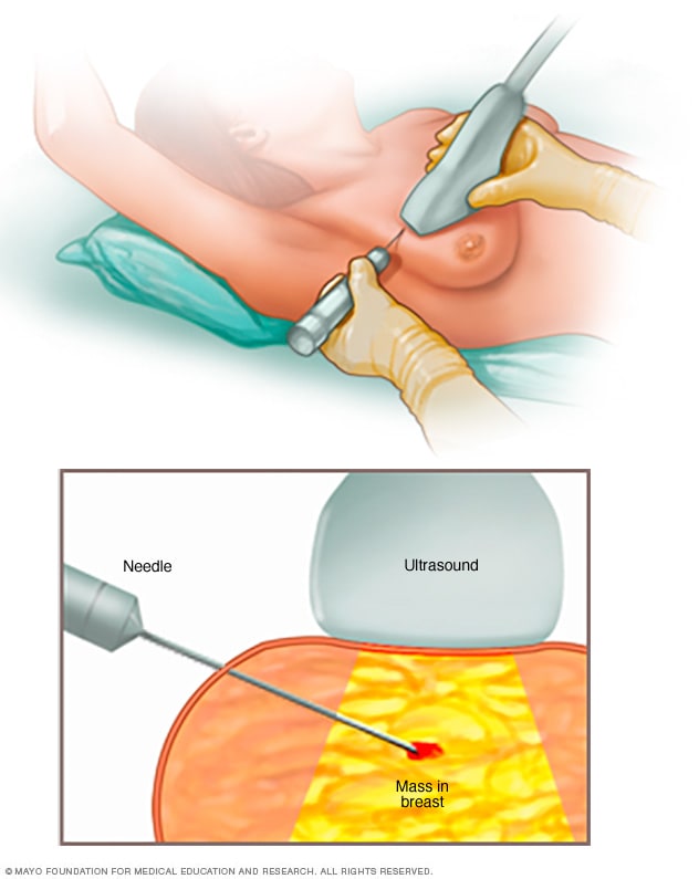 Biopsia por aguja de núcleo
