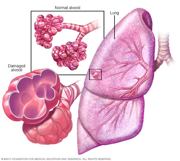 Emphysema