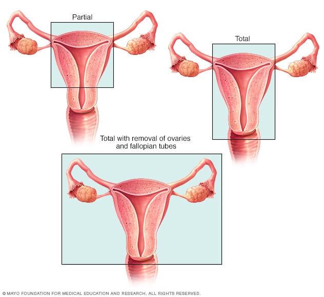 Types of hysterectomy