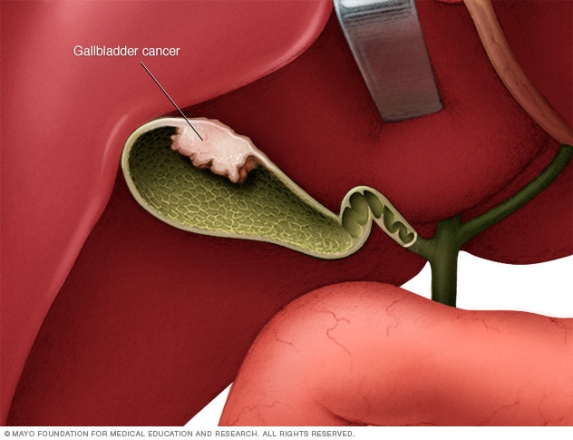 Gallbladder cancer - Mayo Clinic