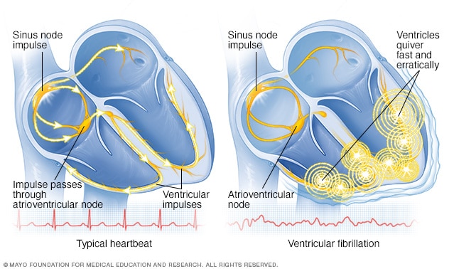 Ventricular fibrillation - Symptoms and causes - Mayo Clinic